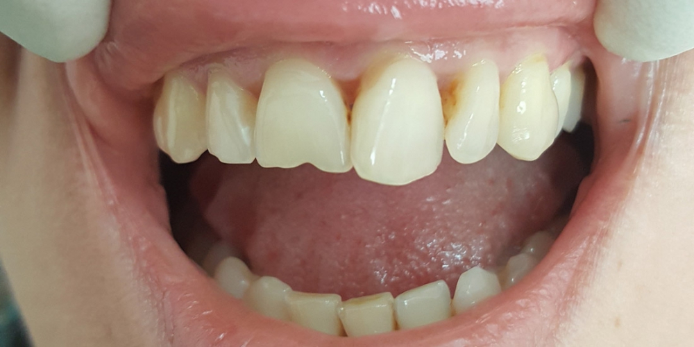  Эстетическая реставрация передних зубов, устранение сколов