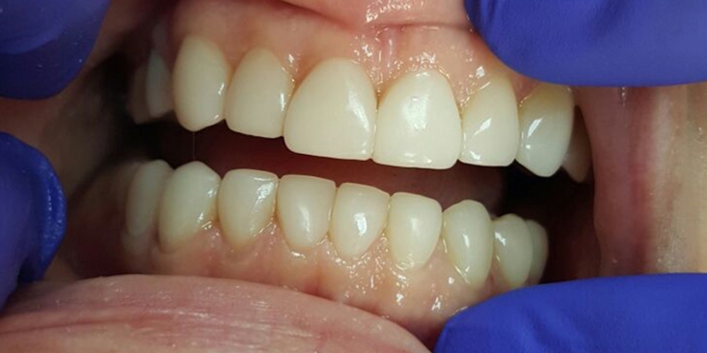  Эстетическая реставрация зубов за 2 приема