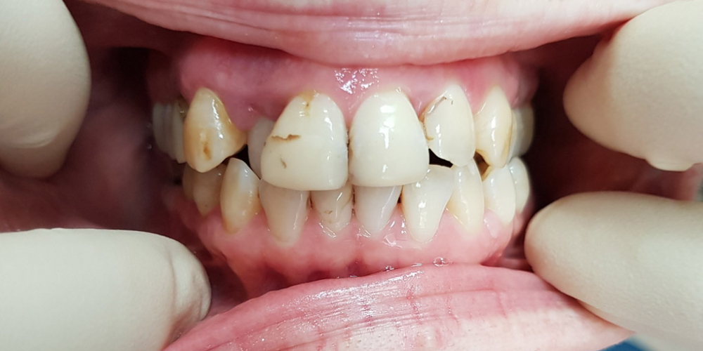  Эстетическая реставрация переднего зуба