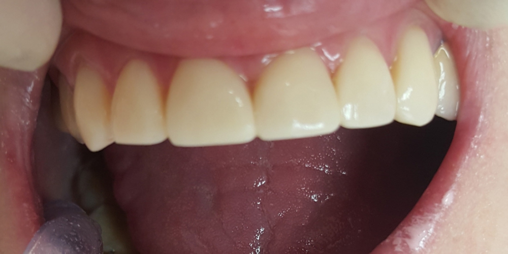  Закрытие тремы между передними зубами