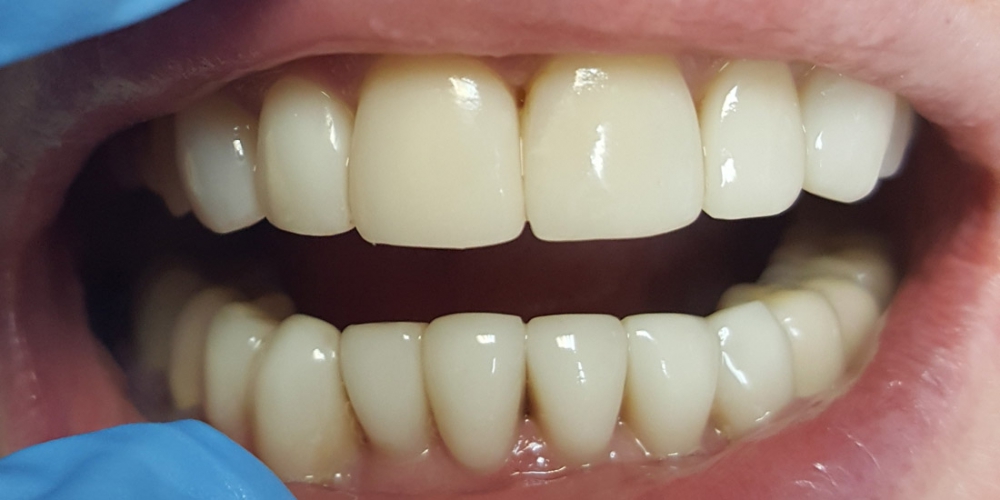  Эстетическая реставрация передних зубов верхней и нижней челюсти с изменением цвета на более светлый