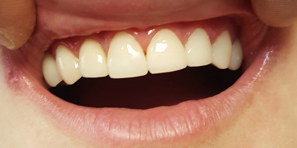  Эстетическая реставрация 10 передних зубов в цвет