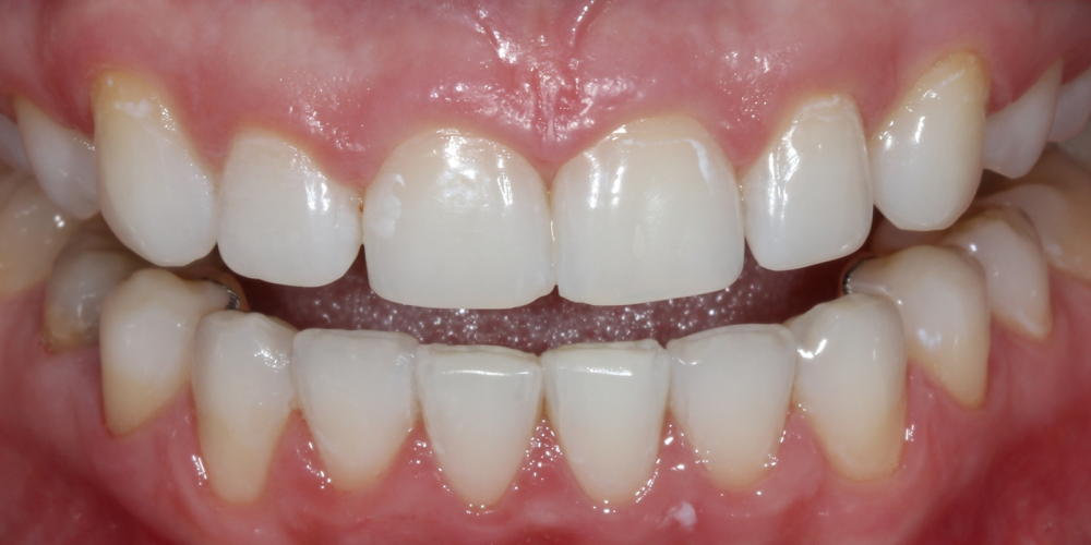  Результат профессионального отбеливания зубов Zoom 4