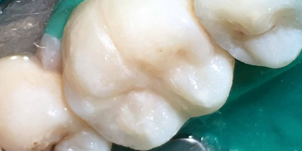  Результат лечения кариеса жевательного зуба