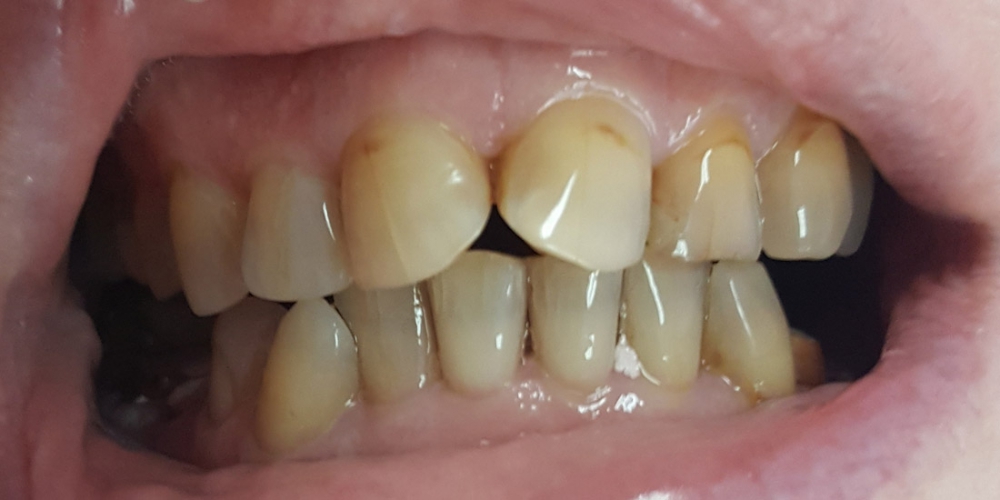  Эстетическая реставрация передних зубов верхней и нижней челюсти с изменением цвета на более светлый