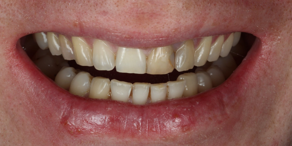  Неудовлетворительный эсететический вид центральных зубов