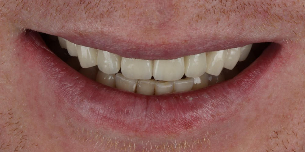  Неудовлетворительный эсететический вид центральных зубов
