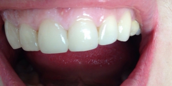 Реставрация верхних передних зубов фото после лечения