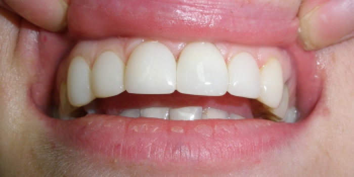Эстетическая реставрация верхнего зубного ряда фото после лечения