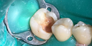 Реставрация 46 зуба по силиконовому ключу фото до лечения