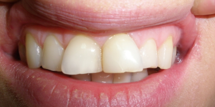 Эстетическая реставрация верхнего зубного ряда фото до лечения