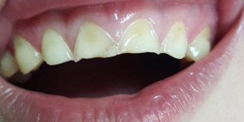 Эстетическая реставрация 10 передних зубов в цвет фото до лечения