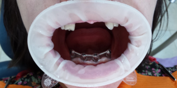 Полное восстановление отсутствия зубов нижней и верхней челюсти фото до лечения