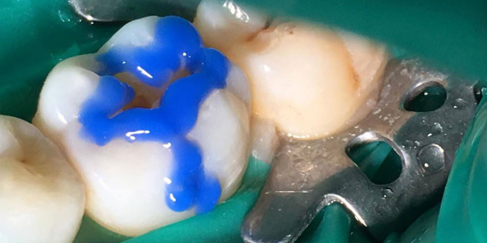  Результат лечения кариеса жевательного зуба