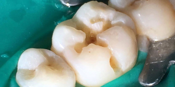 Результат лечения кариеса жевательного зуба фото до лечения