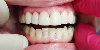 Эстетическая реставрация переднего зуба фото после лечения