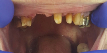 Перепротезирование зубов металлокерамикой фото до лечения