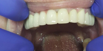 Перепротезирование зубов металлокерамикой фото после лечения